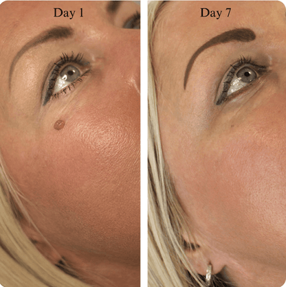 Hopyl™ PielNueva Kit