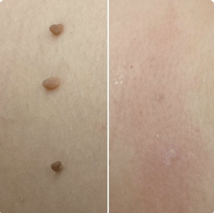 Hopyl™ PielNueva Kit