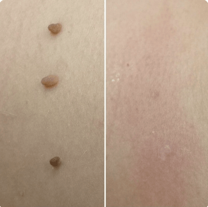 Hopyl™ PielNueva Kit