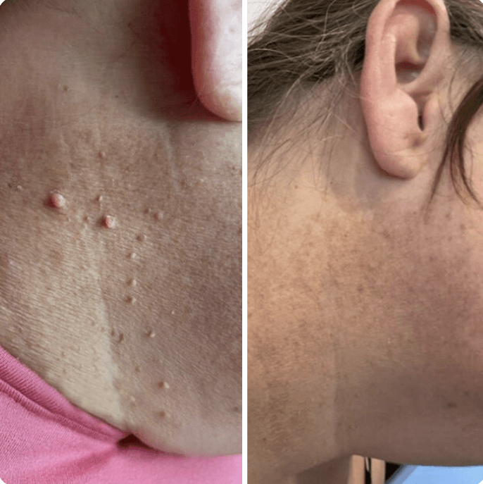 Hopyl™ PielNueva Kit