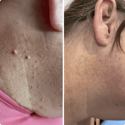 Hopyl™ PielNueva Kit