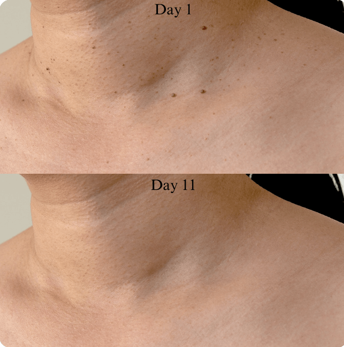 Hopyl™ PielNueva Kit