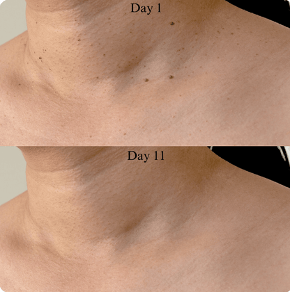 Hopyl™ PielNueva Kit