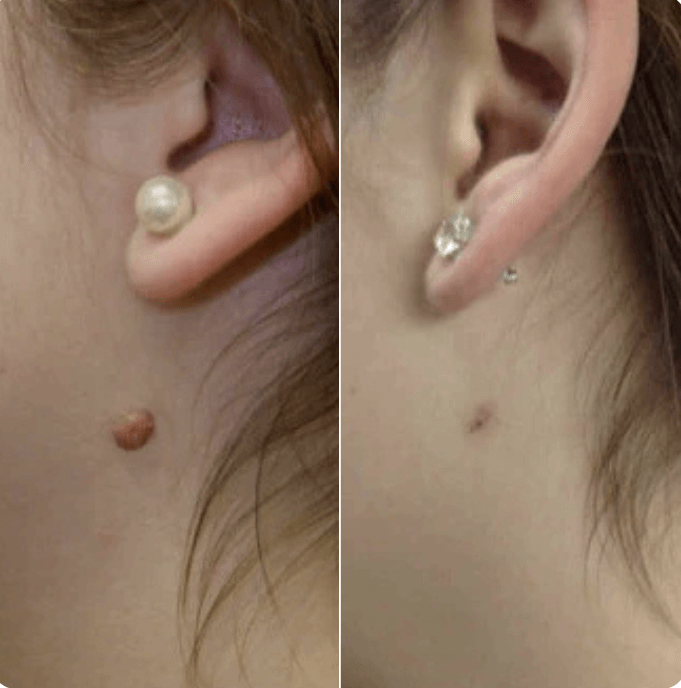 Hopyl™ PielNueva Kit