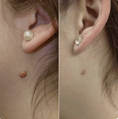 Hopyl™ PielNueva Kit